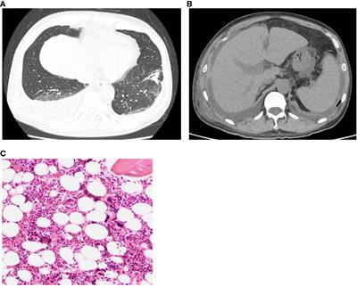 Case Report: A case of TAFRO syndrome with severe and prolonged thrombocytopenia: diagnostic pitfalls